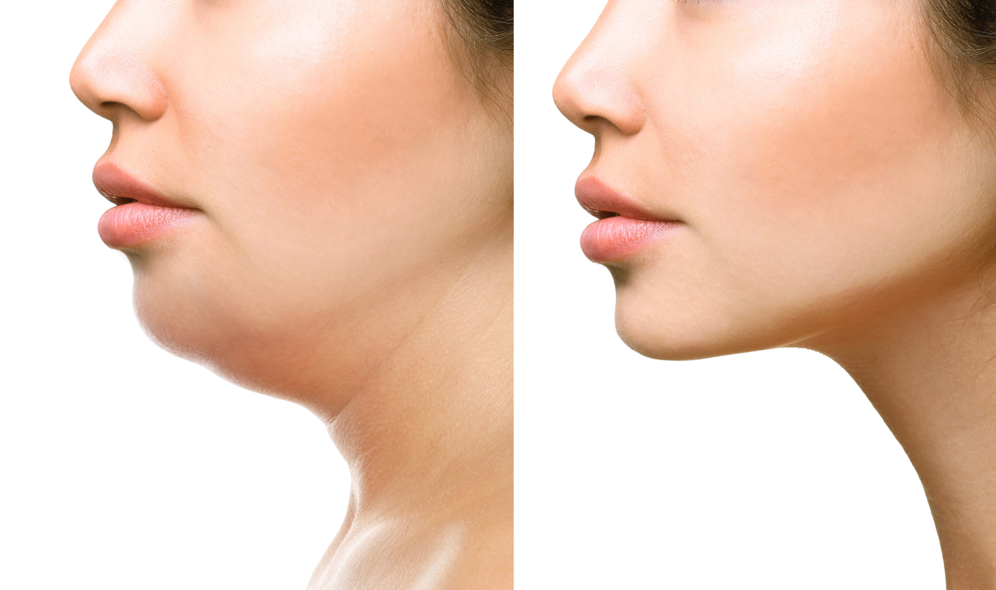 How Does Kybella Work?