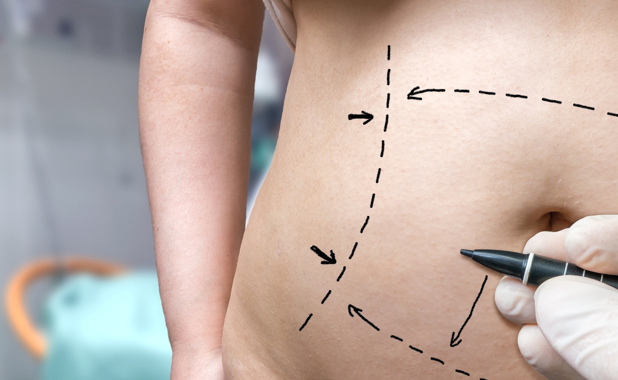 Abdominoplasty vs Panniculectomy: What Are the Differences?