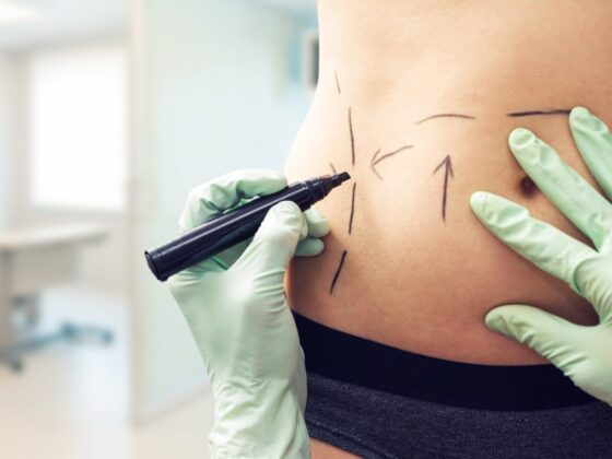 5 Tips to Know to Get the Best Tummy Tuck Results