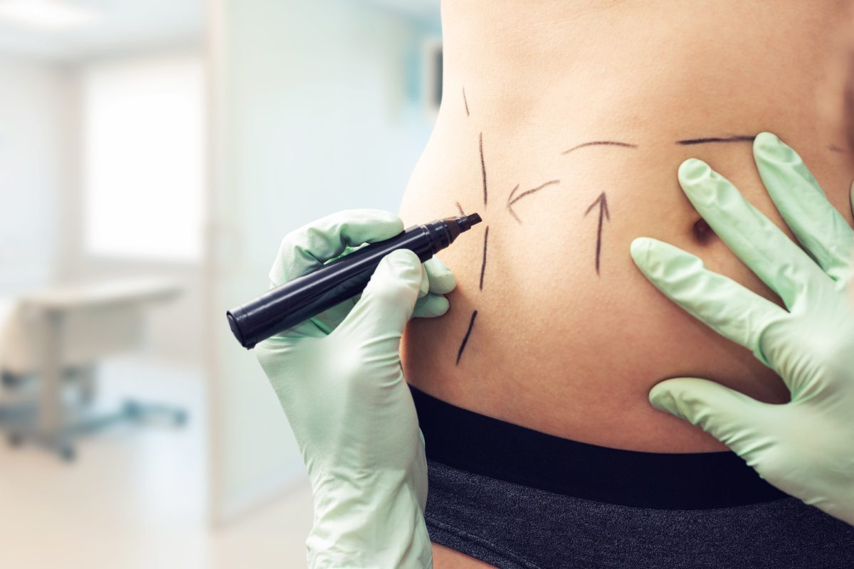 5 Tips to Know to Get the Best Tummy Tuck Results