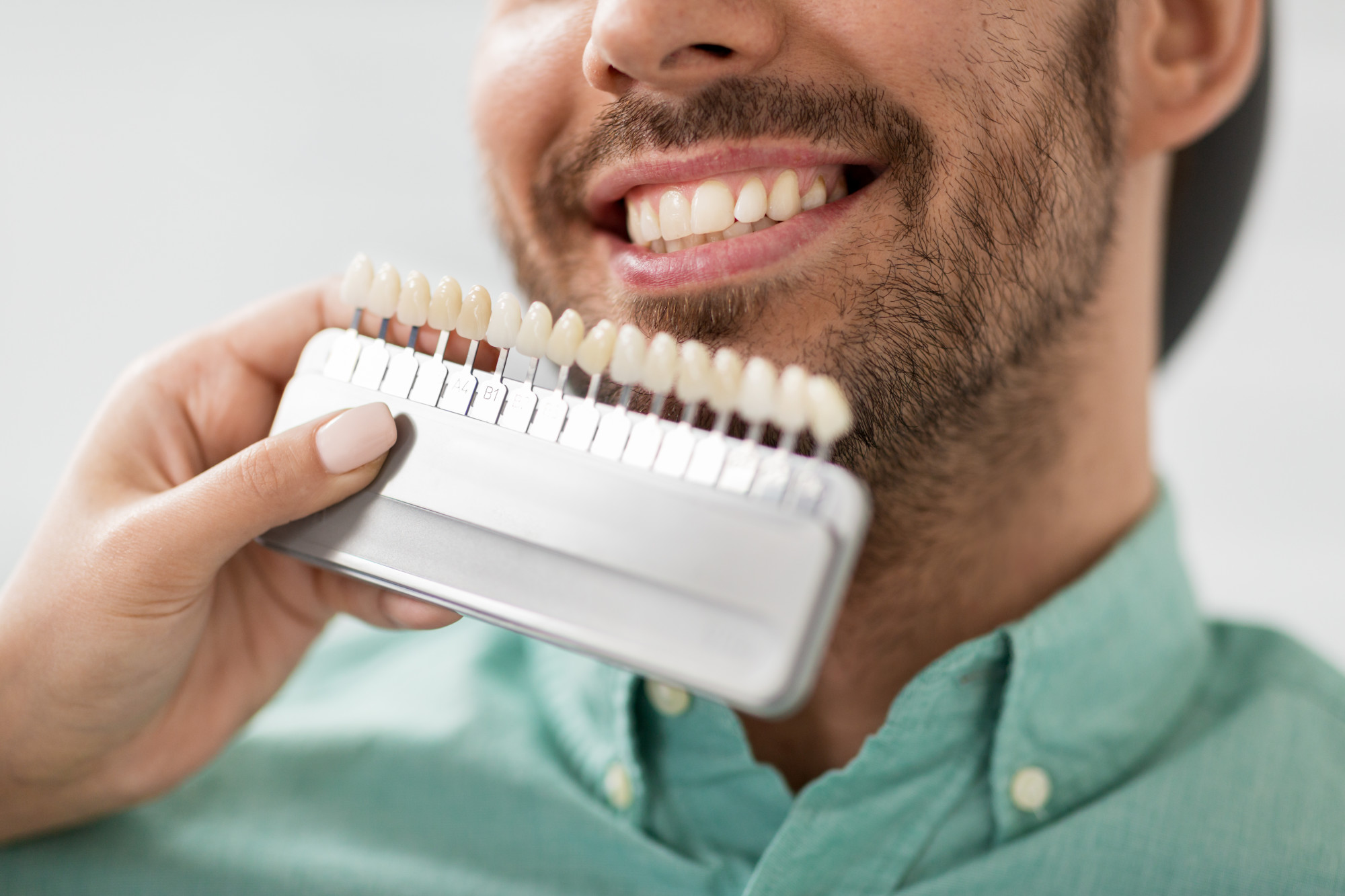 What Are Dental Veneers and How Can They Benefit You?
