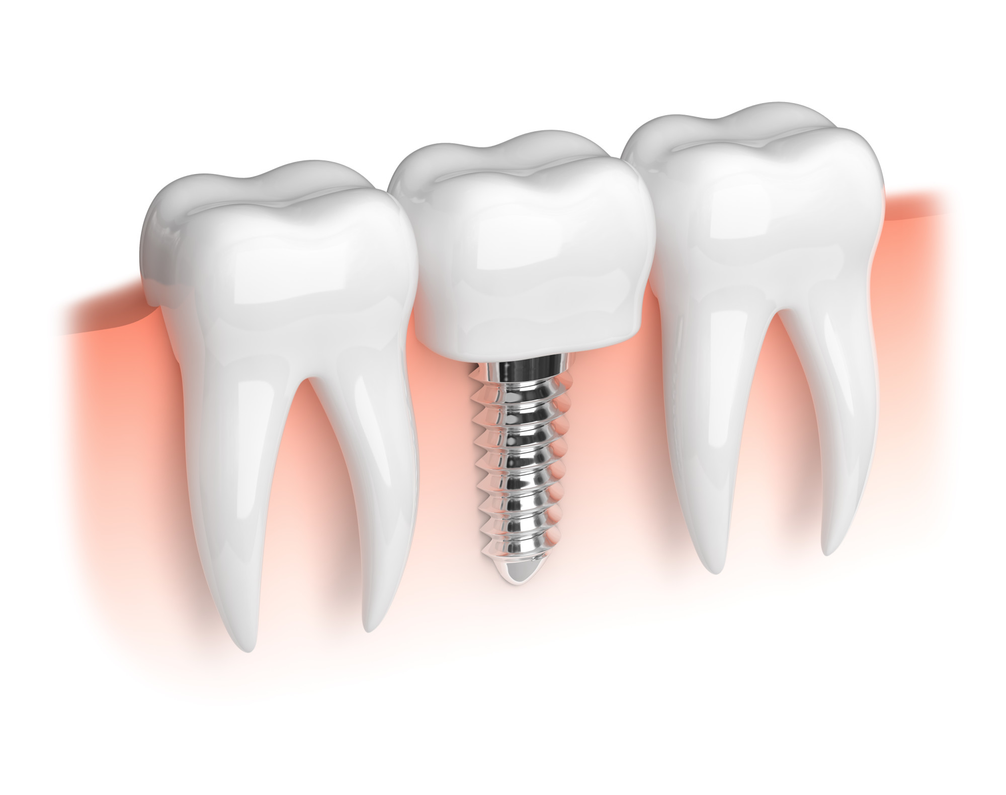 How to Choose Implant Dentists: Everything You Need to Know
