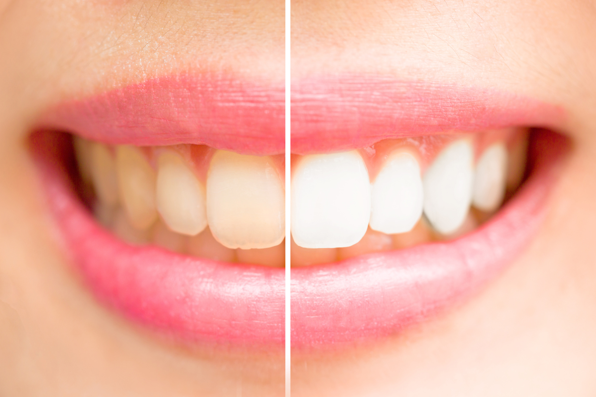 How Much Does It Cost to Get Your Teeth Whitened?