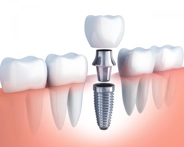 Insidexpress how can you benefit from dental implants how can you benefit from dental implants 1
