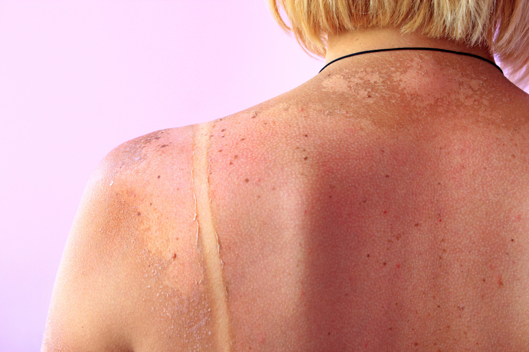 Which Type of Skin Cancer Is the Most Common?