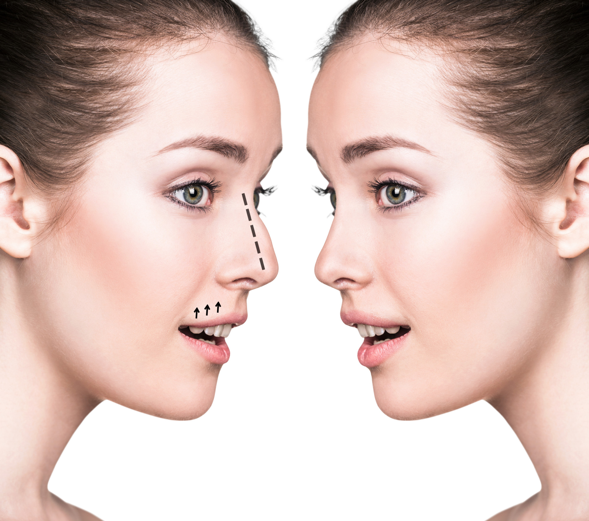 3 Things to Know About Removing a Nose Hump With Rhinoplasty