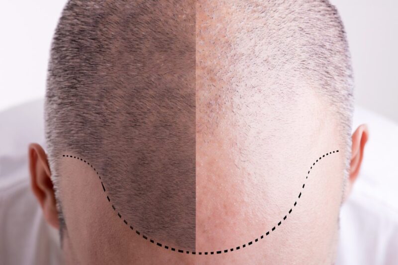 Is a Bald Hair Tattoo a Good Idea for You?