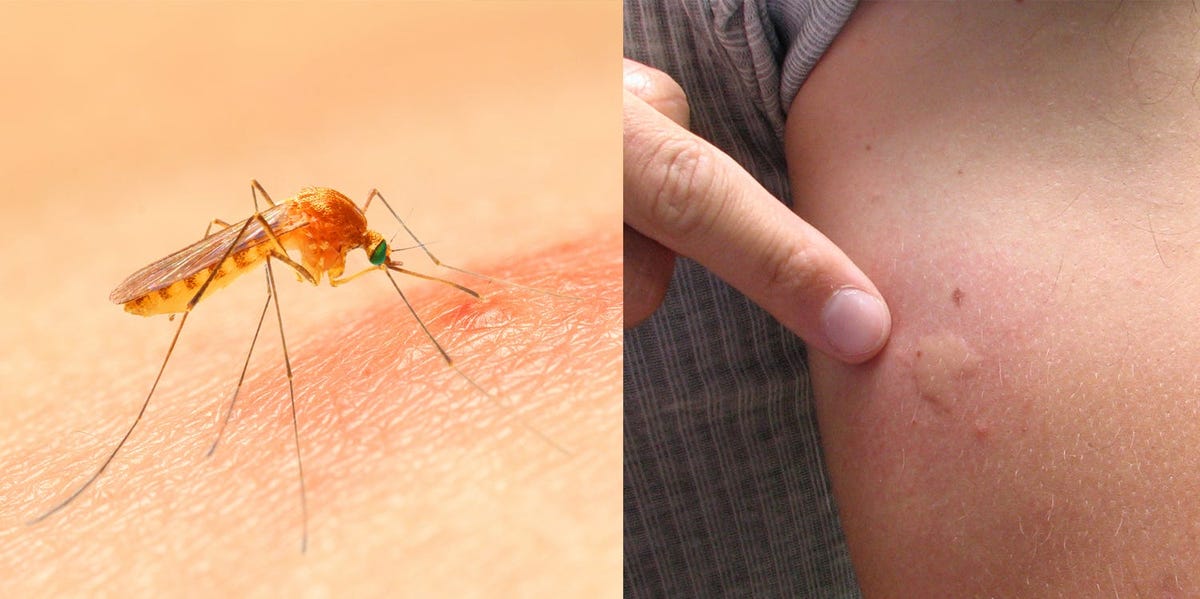 Why Do Mosquito Bites Itch? Mosquito Saliva Is the Culprit